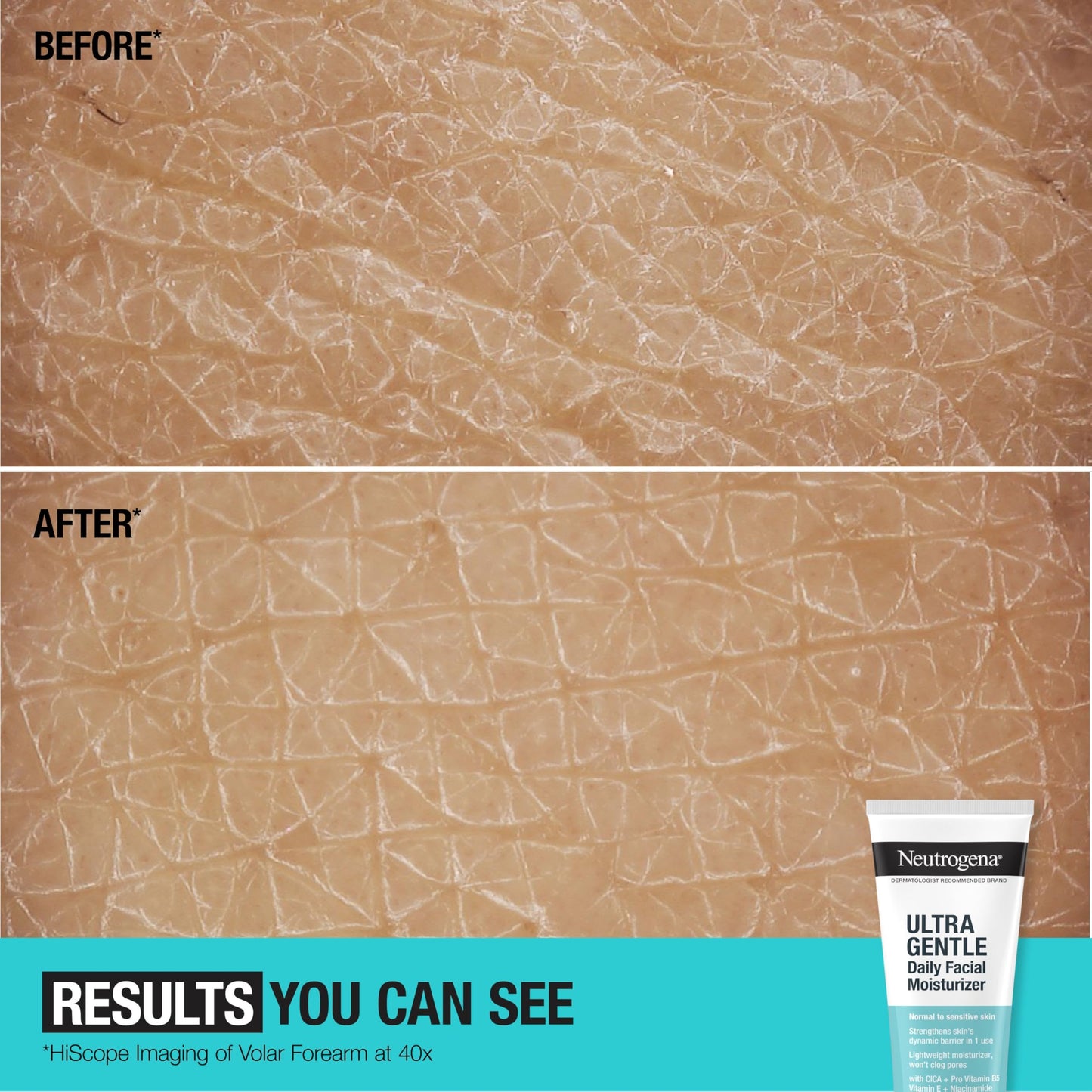 Neutrogena Face Moisturizer Ultra Gentle Daily Face Moisturizer for Sensitive Skin with Vitamin B3, Pro-Vitamin B5, and Vitamin E, Hydrating Moisturizer, 3.4 fl oz